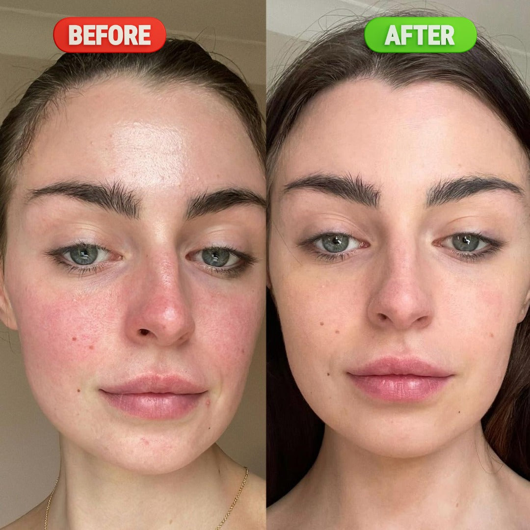 Anti-Acne Serum – 30ML