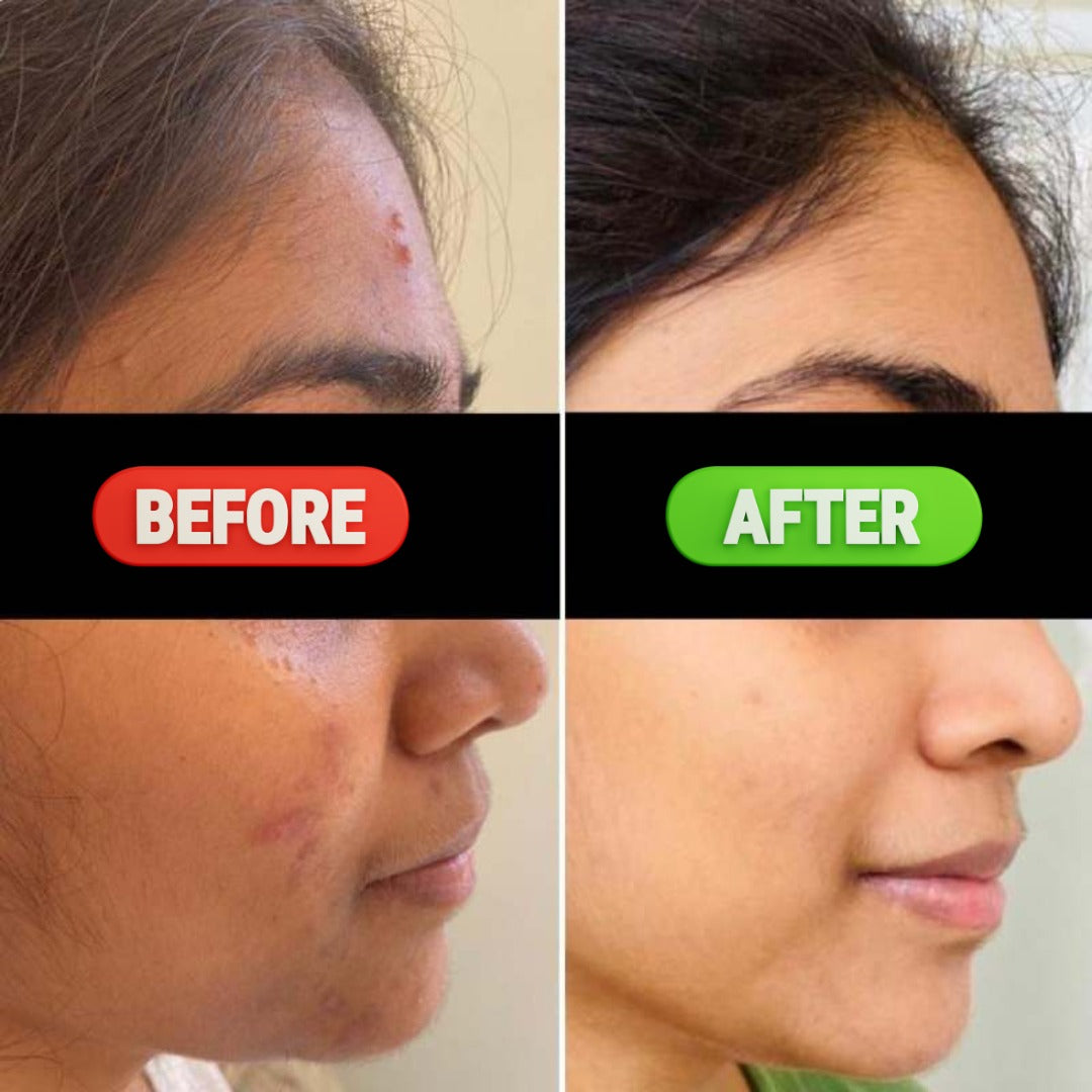 Anti-Acne Serum – 30ML