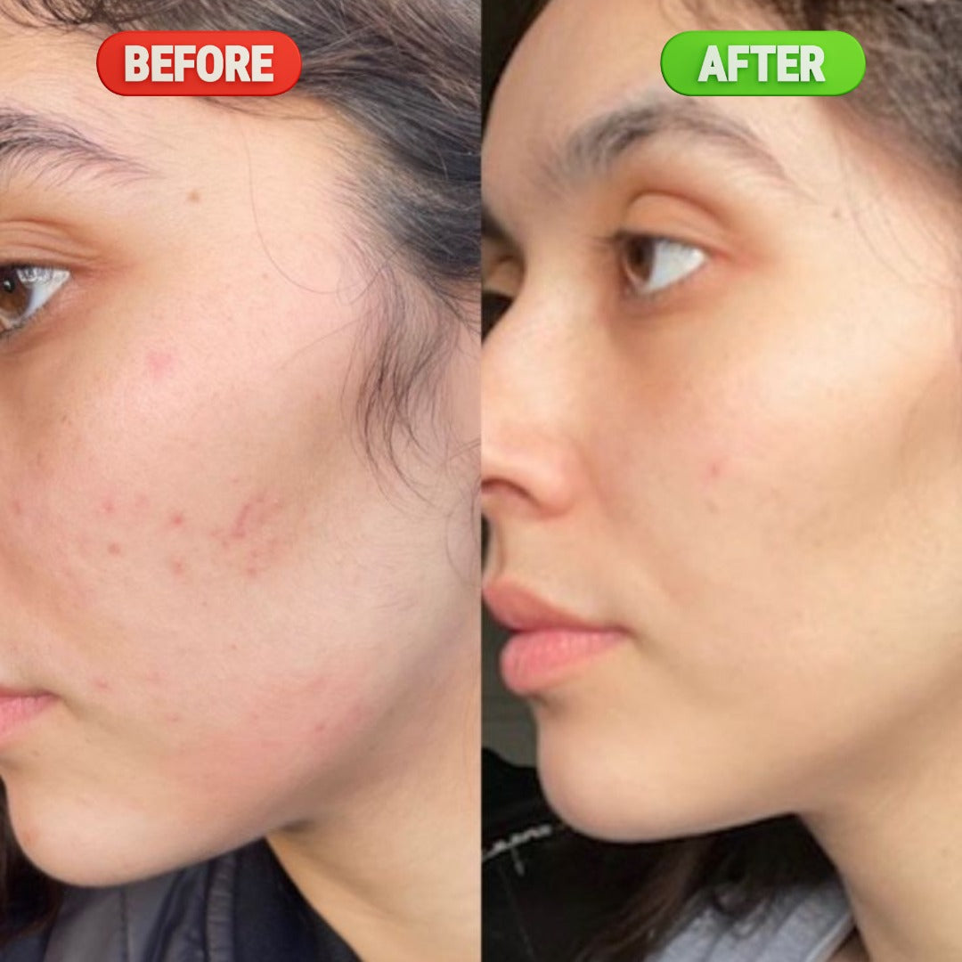 Anti-Acne Serum – 30ML