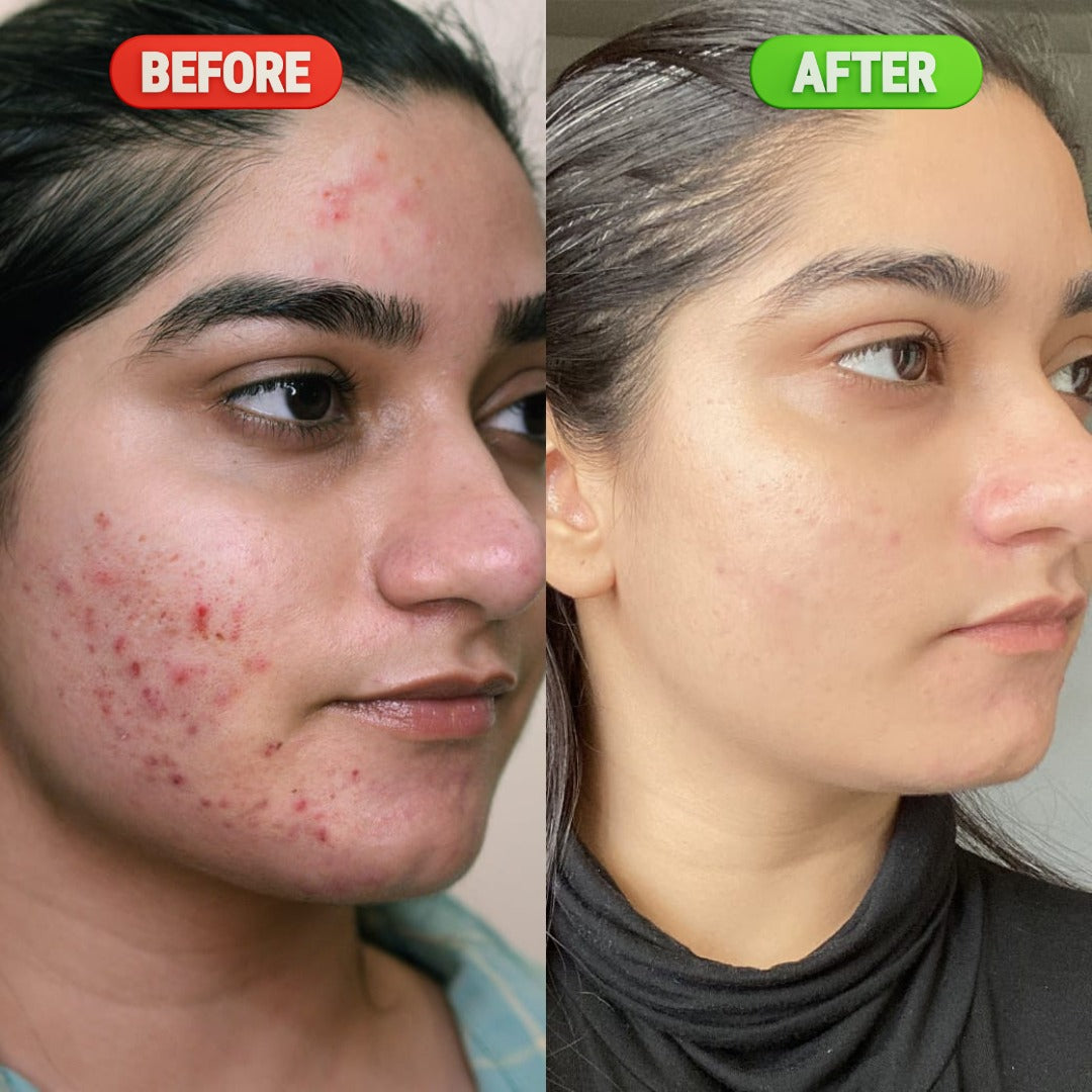 Anti-Acne Serum – 30ML